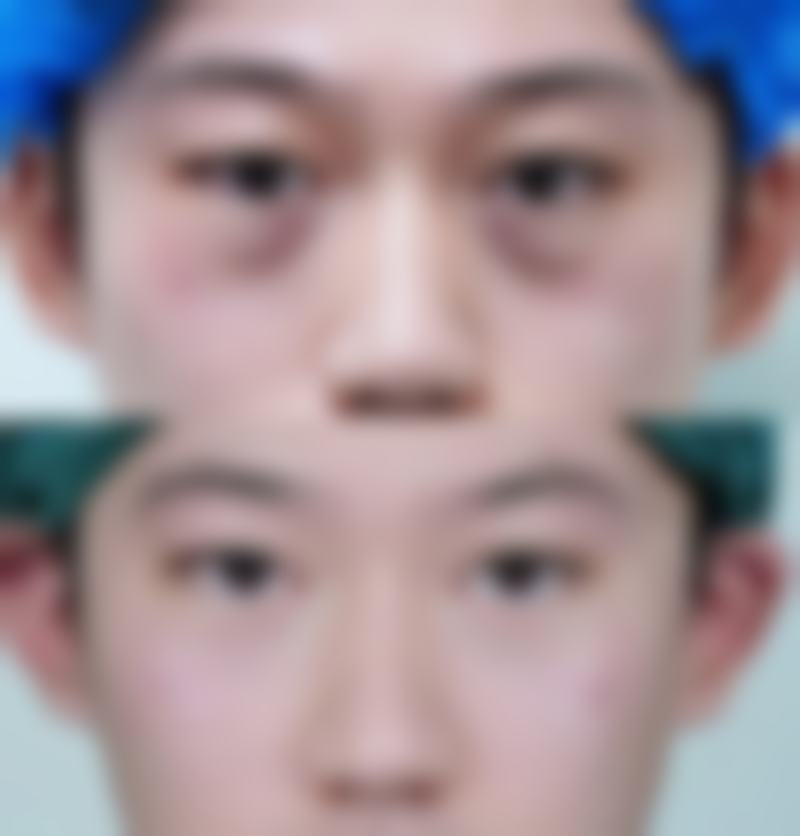 五、去除眼袋浮肿的误区