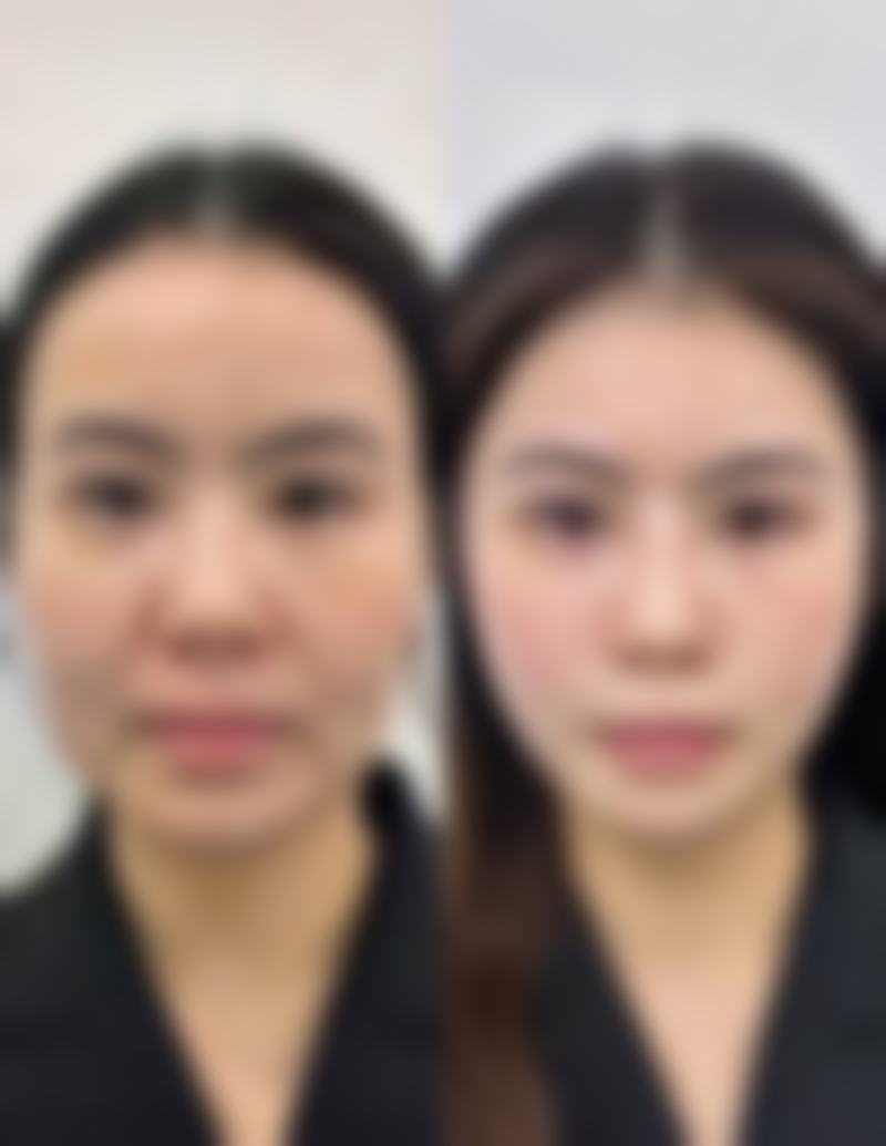 五、隆鼻修复多久自然：不同阶段的注意事项