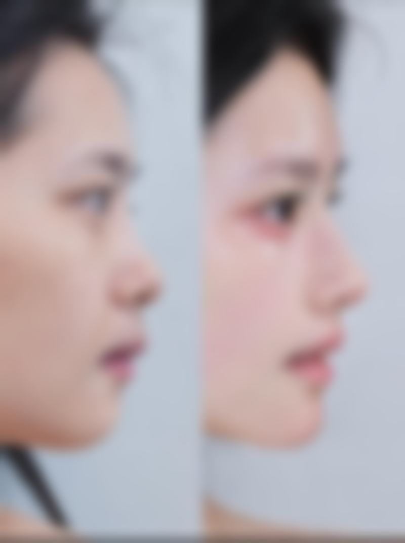 二、“眼袋打针有副作用吗”——常见副作用揭秘