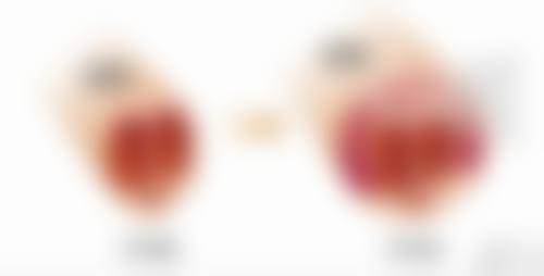 四、开眼角割双眼皮修复过程中的注意事项