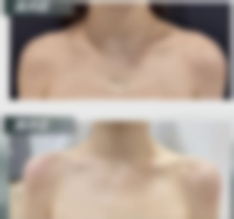 三、开眼角割双眼皮不同阶段的修复情况