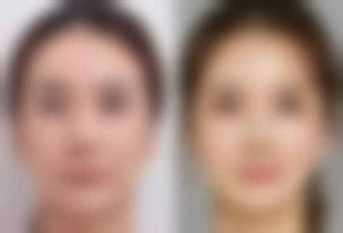 二、双眼皮做完出血的处理方法