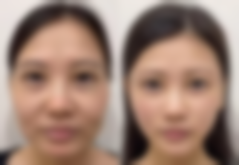 三、全切法割双眼皮