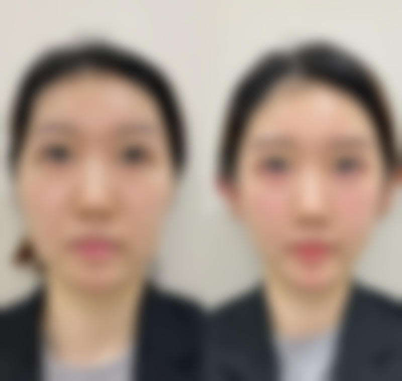 三、点阵激光去除红色凹陷疤痕