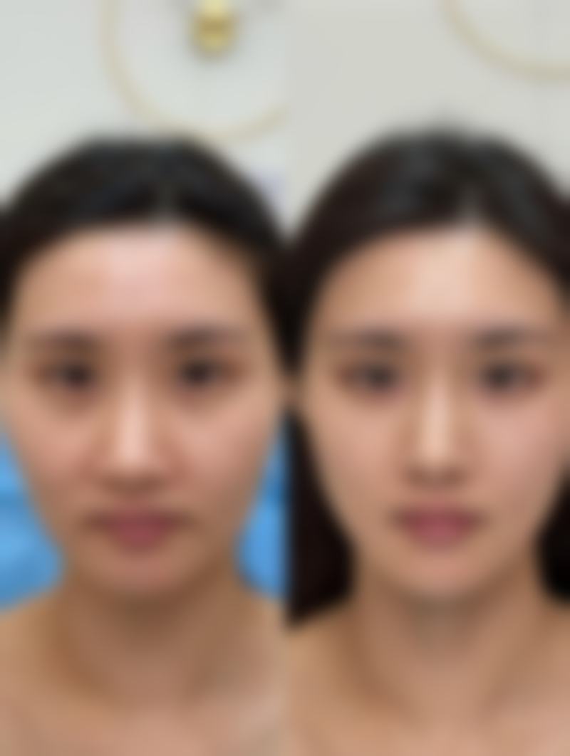 隆胸什么牌子的假体软？综合选择特别重要