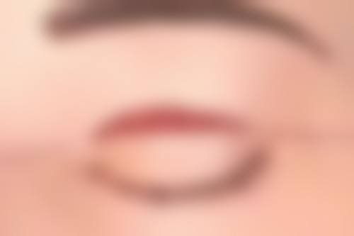 一、倾美不开刀祛眼袋医生赵涛院长的实力