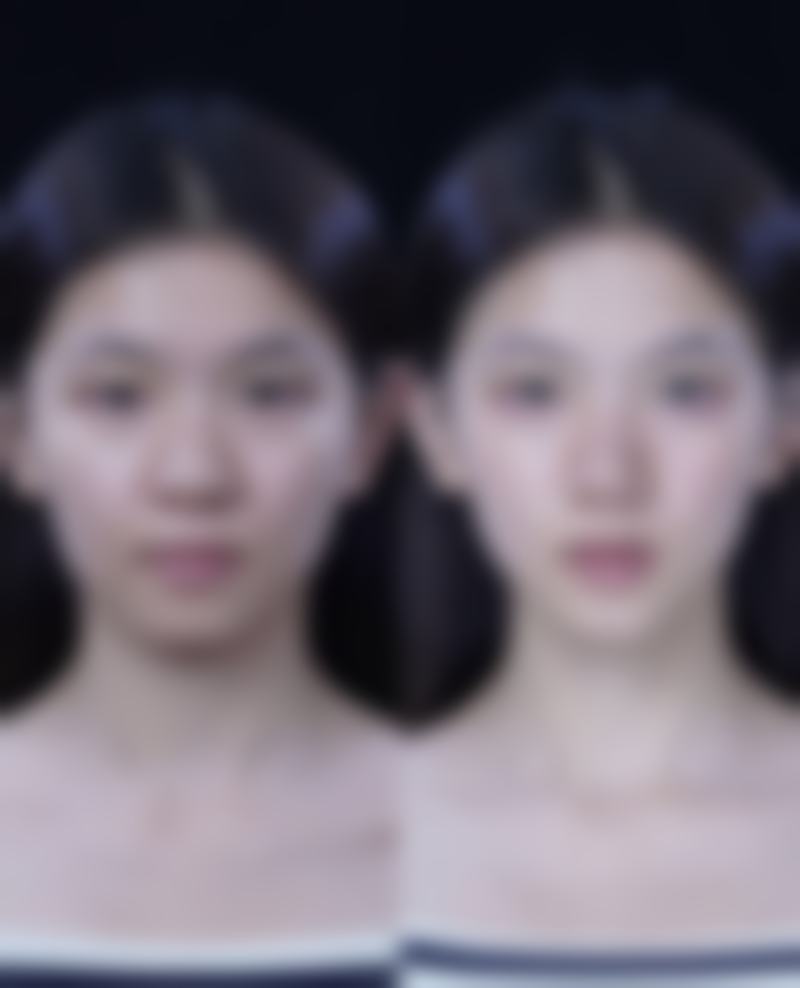 三、超体隆鼻的缺点
