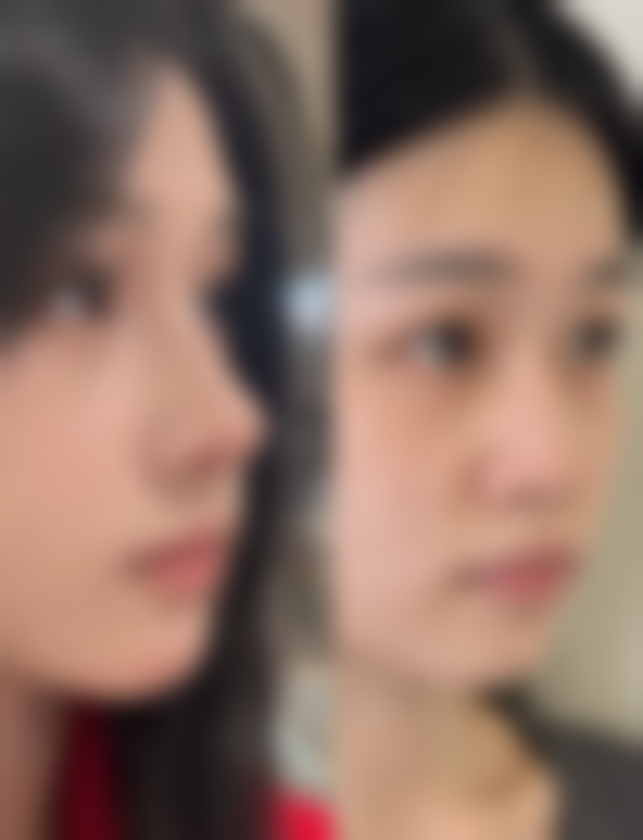 五、倾美不开刀去眼袋的适应人群