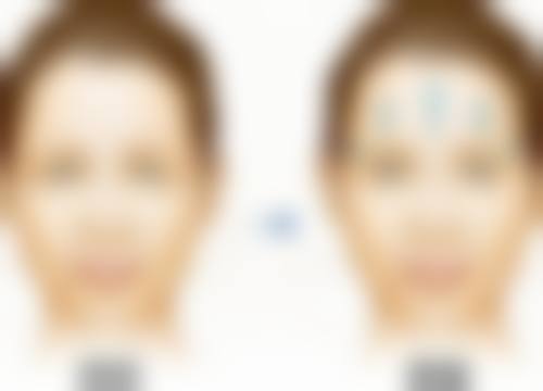 四、如何缩短全切双眼皮修复的修复时间