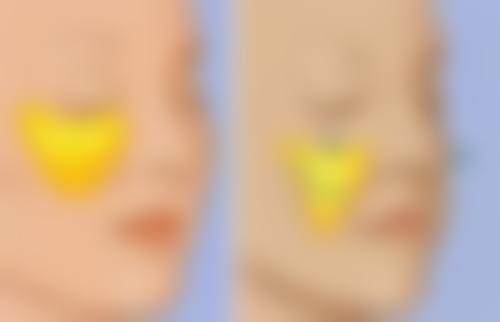 {全切双眼皮修复要多久才能恢复？受多种因素影响，恢复时间大不同！ 