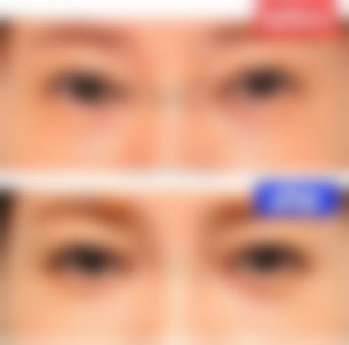 八、温州眼谷超级眼视光医院医疗美容科真实的患者评价