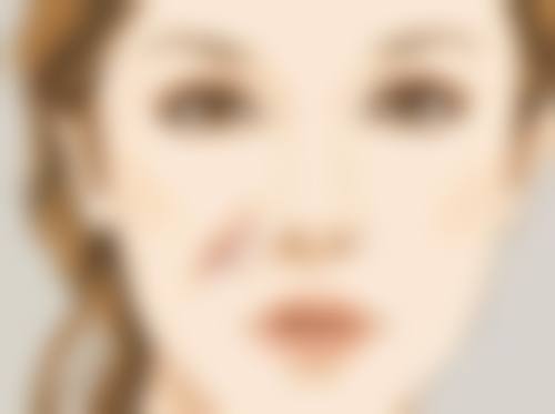 五、修复多年凹陷疤痕的注意事项