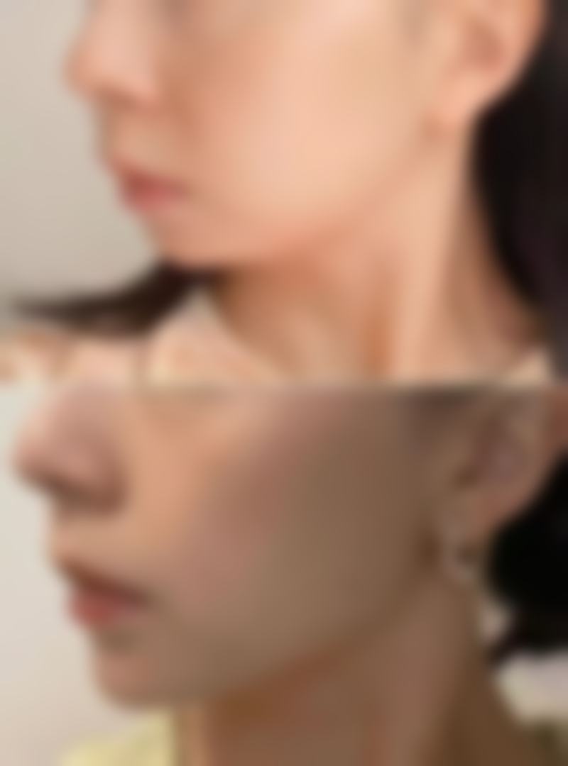 三、如何降低局部抽脂的副作用