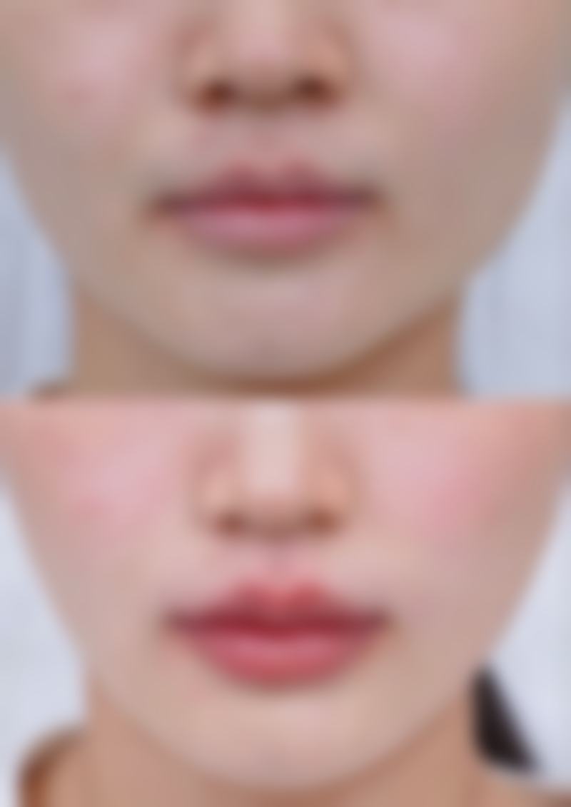 五、如何降低打除皱针的危害