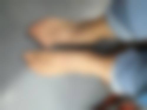 二、腰腹吸脂后反弹的影响因素