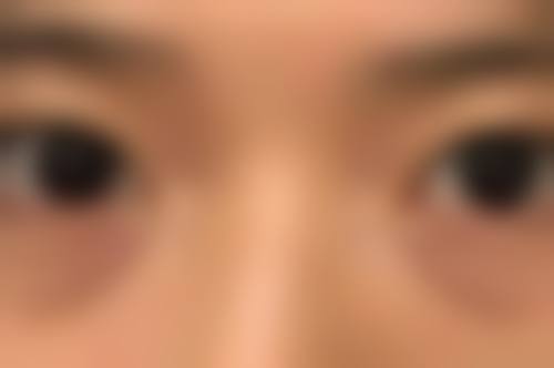 六、硅胶隆鼻挛缩的实例分析