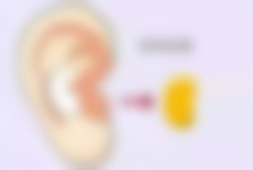 三、不同人群全切双眼皮修复差异