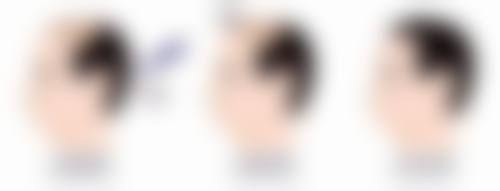 三、打瘦脸针选50单位还是100单位?