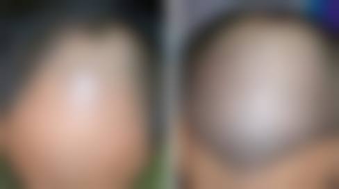 四、柳州新生天美植发特色项目