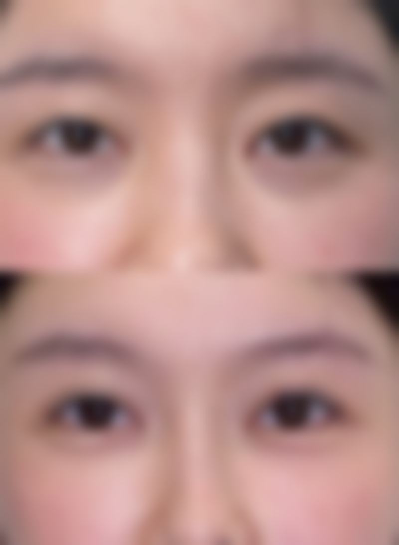 {内切眼袋手术后多久能恢复正常？影响恢复时间的因素及各阶段恢复情况揭秘
