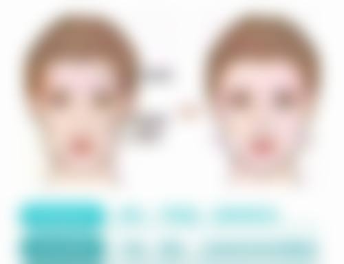 三、假体取出的过程