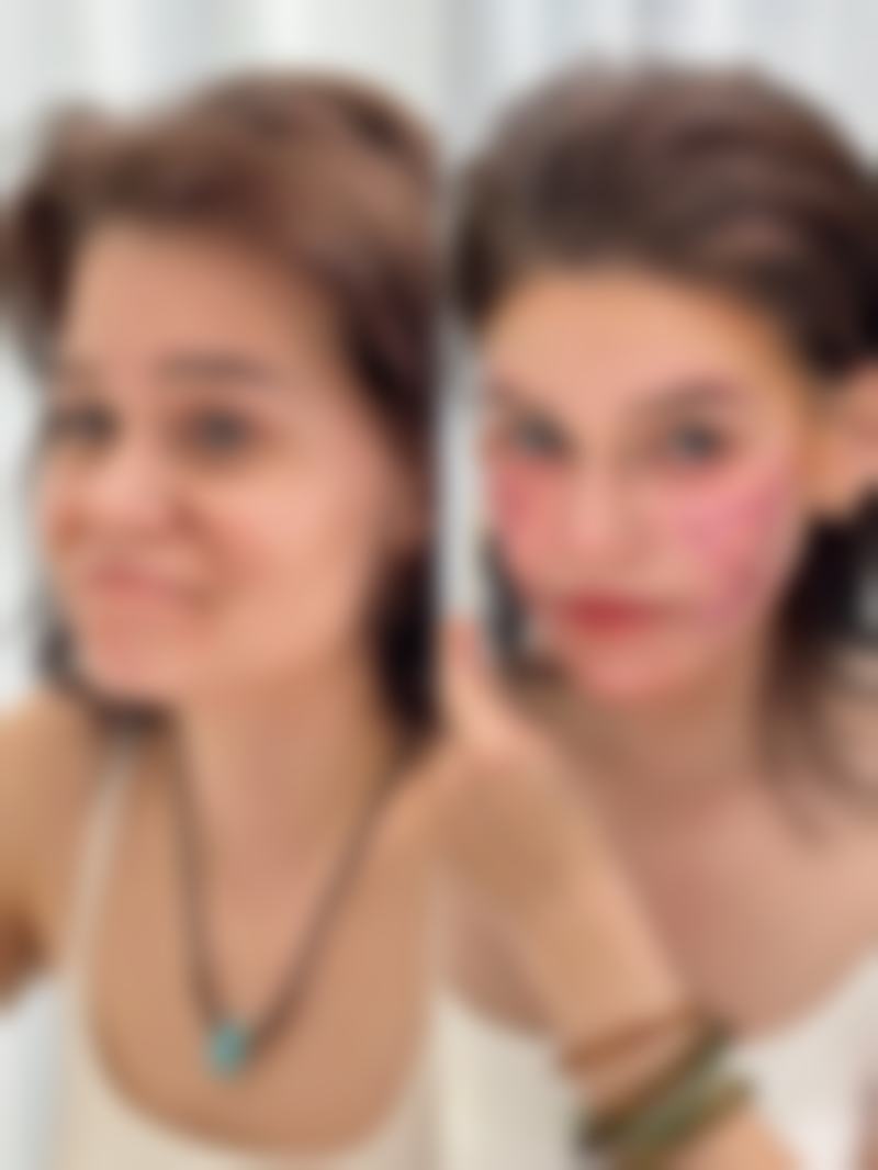 五、去除眼袋的其他方法