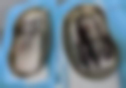 二、眼袋手术后可用的疤痕膏
