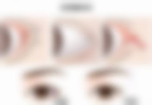 二、注射隆胸的手术方式及对哺乳的影响