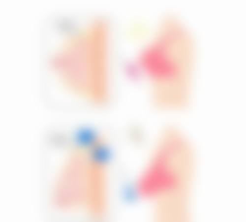 六、双眼皮埋线可以保持多久:应对措施