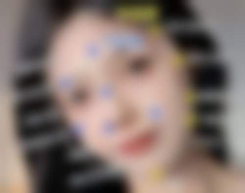 四、影响双眼皮埋线维持时长的因素