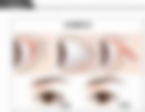 三、成年后改善16岁遗留眼袋的方法