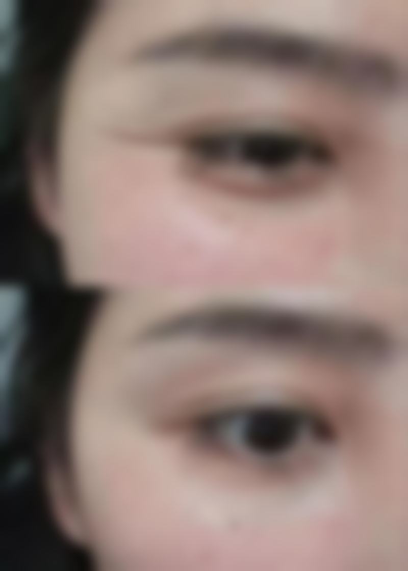 三、双眼皮埋线可以保持多久:大致时间范围