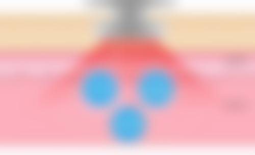 一、异体肋软骨隆鼻的成效优势