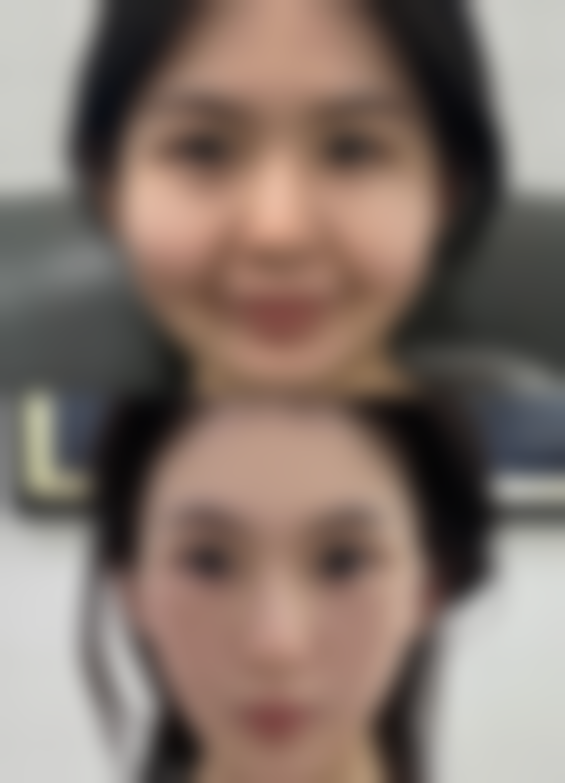 {手臂抽脂和大腿抽脂哪个恢复比较快？了解恢复时间助你轻松变美 