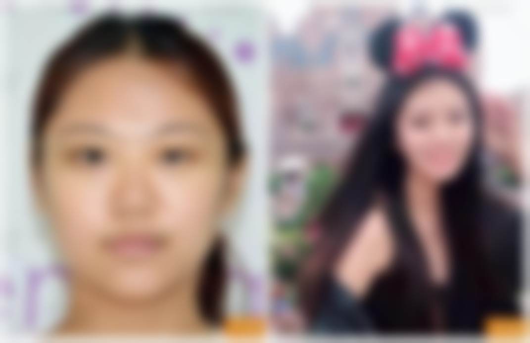 五、北京禾美嘉乔雅登雅致玻尿酸填充的放心美保护