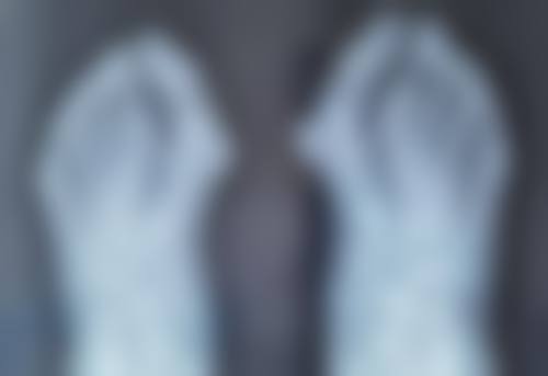 一、了解眼袋形成的原因
