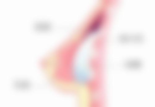 五、非手术去眼袋方法