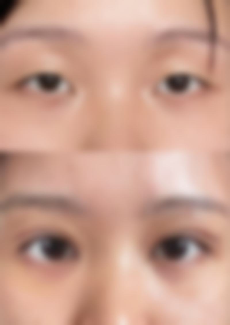 {双眼皮割的太深可以修复吗？多种修复术助你改善割深问题重塑自然双眼皮