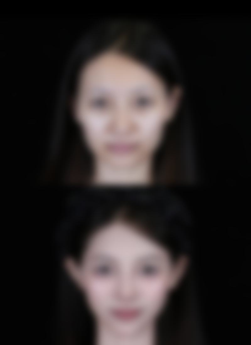 三、打瘦脸针一次能维持多久?