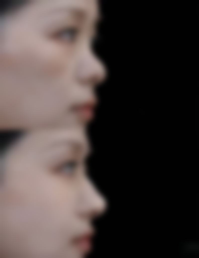 {摔伤的疤痕如何修复好得快？一般护理、药物治疗及激光治疗来助力