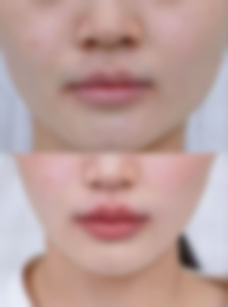 二、单眼皮和双眼皮哪个多一点之整形因素