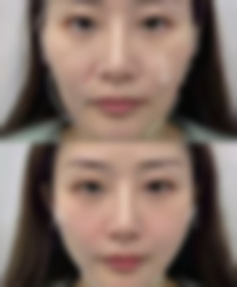 二、全切双眼皮术后冷敷