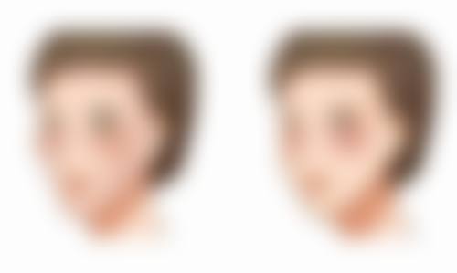 二、双眼皮是埋线好还是全切好吗?从手术预期成效分析