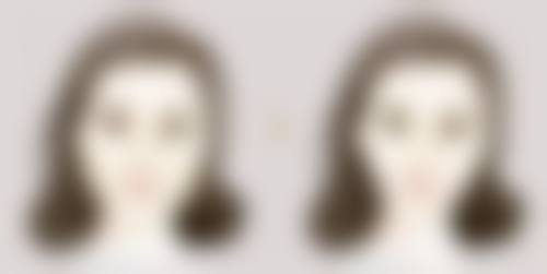 二、做双眼皮有什么副作用吗?割双眼皮常见副作用