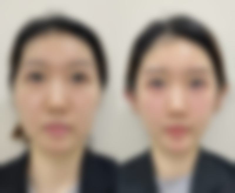五、女生用自己脂肪隆胸的适用人群判断