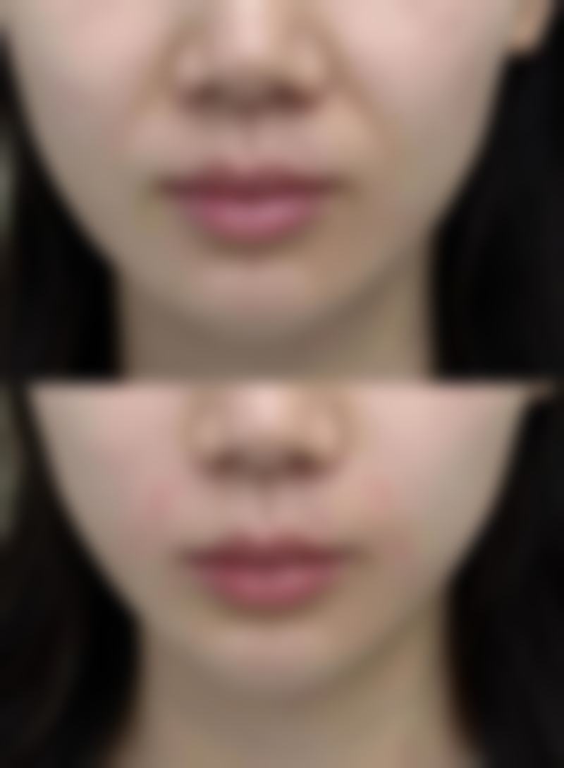 五、纳米无痕和全切双眼皮成效维持时间区别