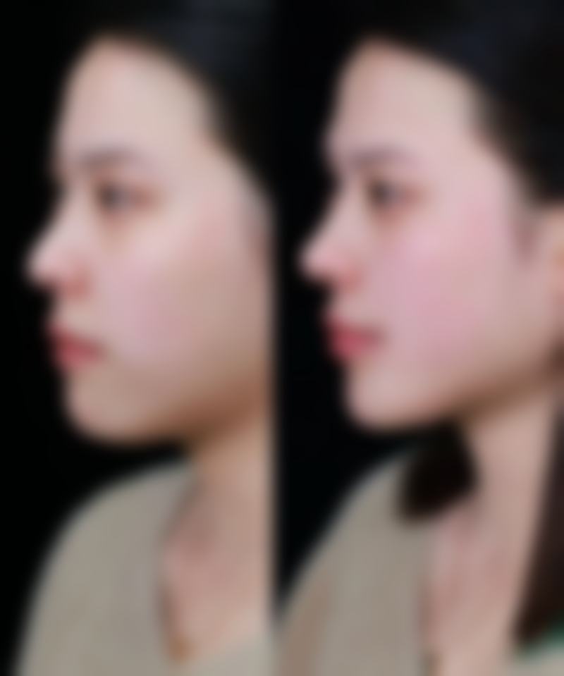 一、女生用自己脂肪隆胸的原理和过程