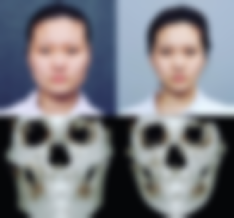 二、女生用自己脂肪隆胸的优点展现
