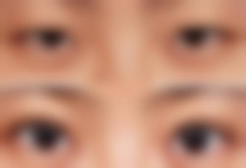 一、假体隆胸材质的重要性
