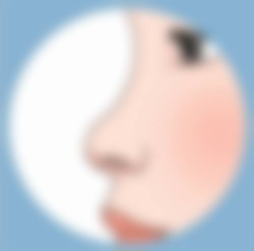 五、过敏与双眼皮变三眼皮